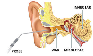 Ear Wax Removal - Cross Section of The Ear